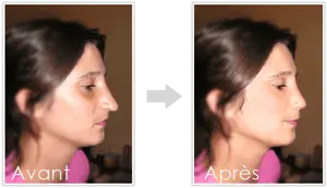 Rhinoplastie nez long Tunisie